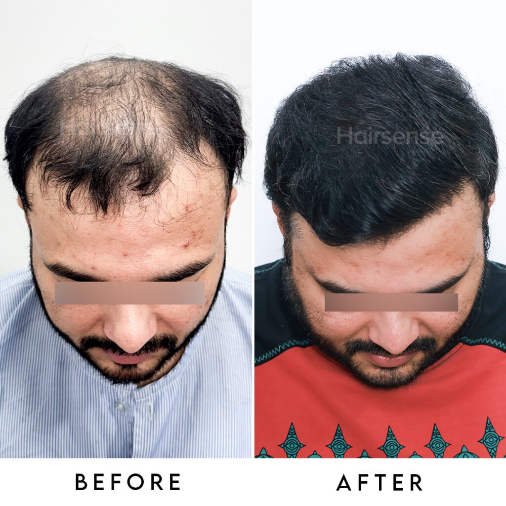 Instagram post from hairsense_hairtransplantclinic. This post is in position 1.