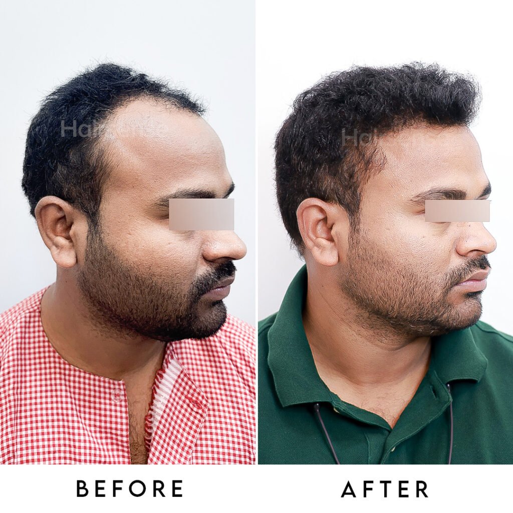 Instagram post from hairsense_hairtransplantclinic. This post is in position 1.