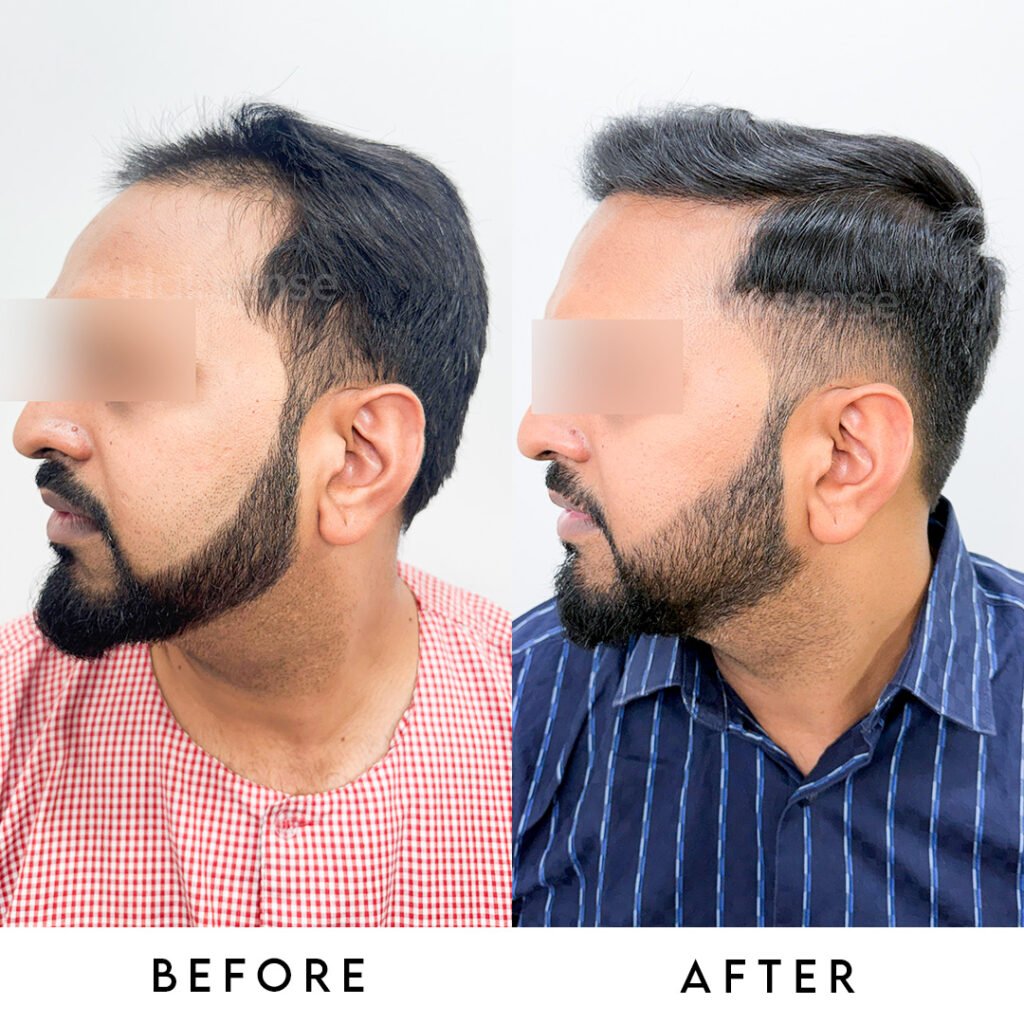 Instagram post from hairsense_hairtransplantclinic. This post is in position 4.