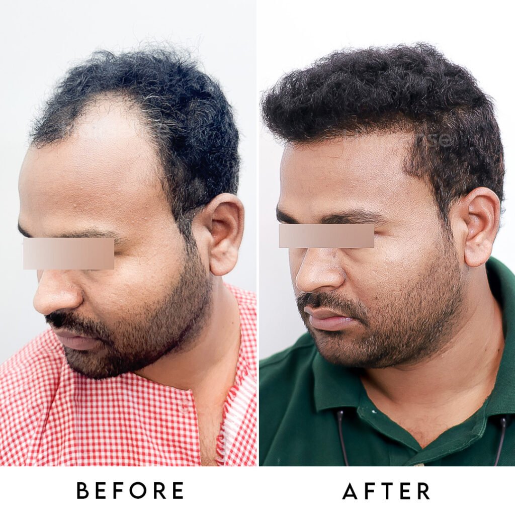 Instagram post from hairsense_hairtransplantclinic. This post is in position 3.