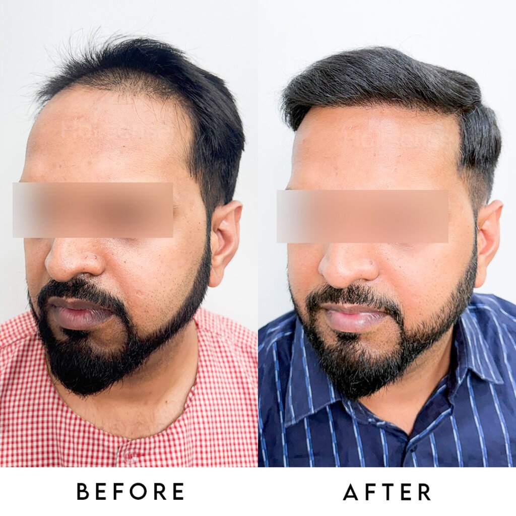 Instagram post from hairsense_hairtransplantclinic. This post is in position 3.